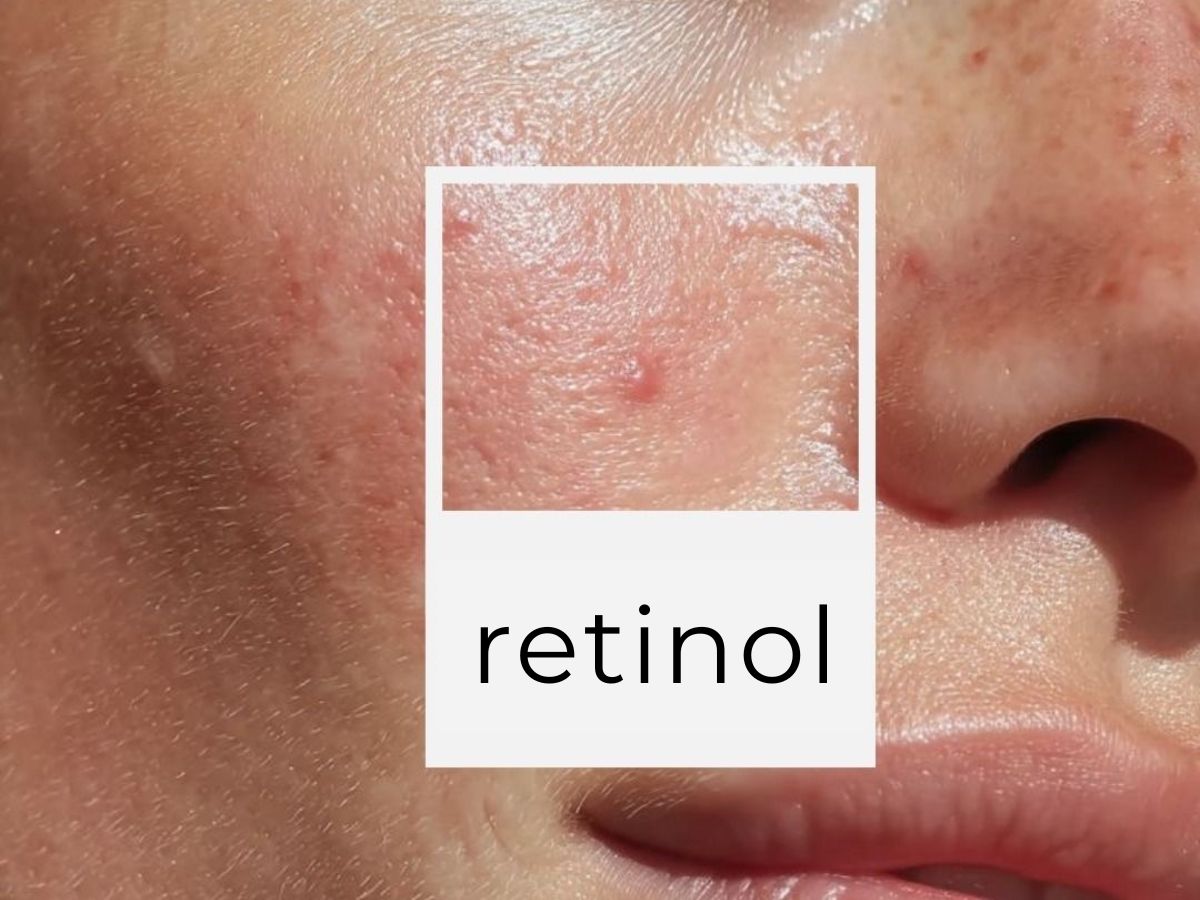 wysyp po retinolu